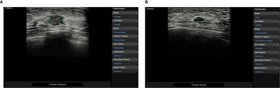 Artificial Intelligence in Medical Imaging of the Breast